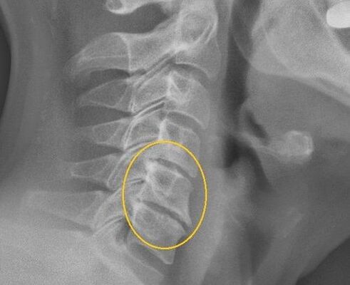 X -Ray сайтындагы моюнчанын омурткасынын остеофондрозу